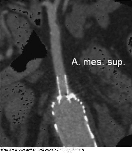 CT - MIP-Rekonstruktion