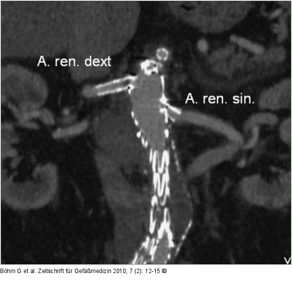CT - MIP-Rekonstruktion