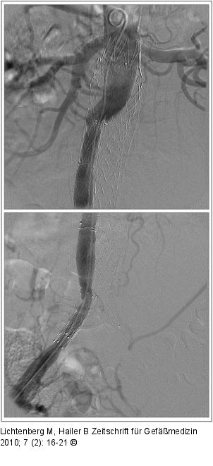 Aortenstentgraft