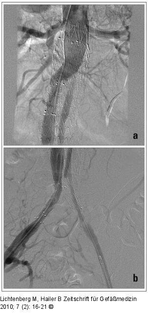 Aortenstentgraft