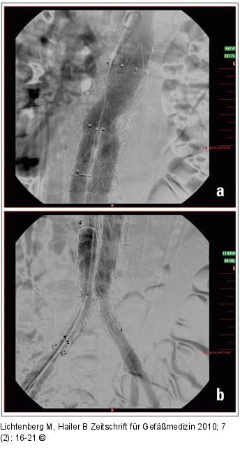 Aortenstentgraft