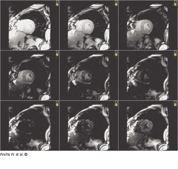 Cardiac MR