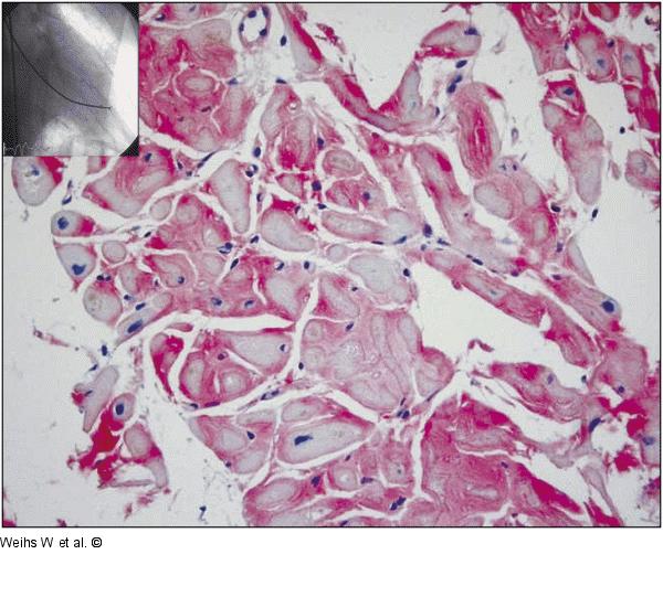 Histologie der Myokardbiopsie