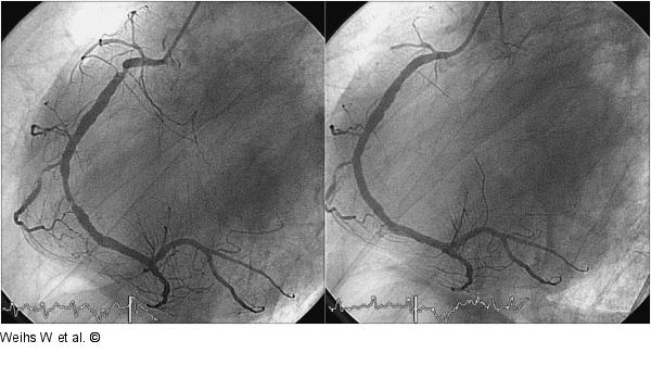 Koronararterie 