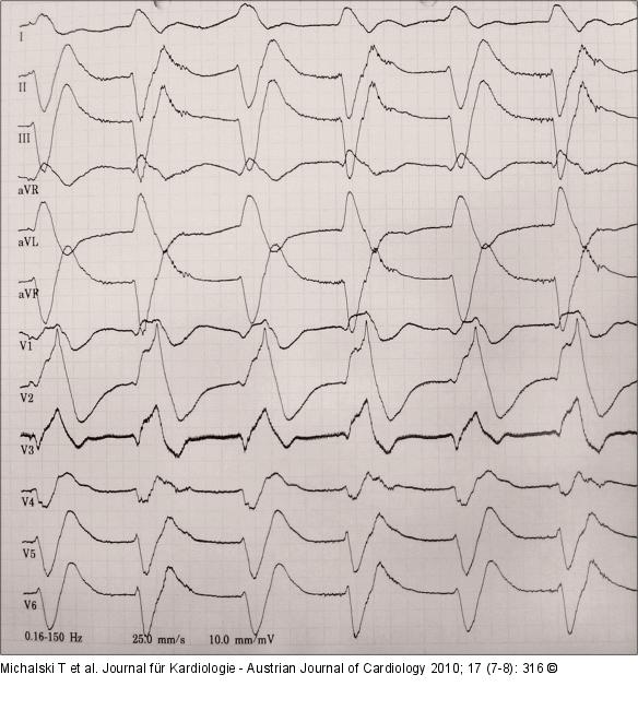 EKG