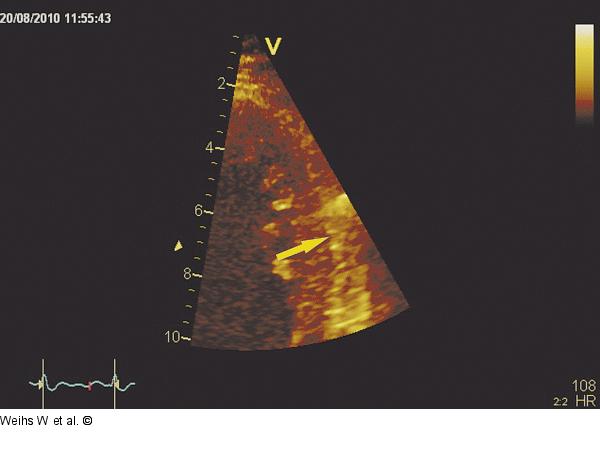 Apikales anterolaterales Segment