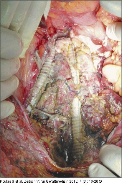 Aortenaneurysma