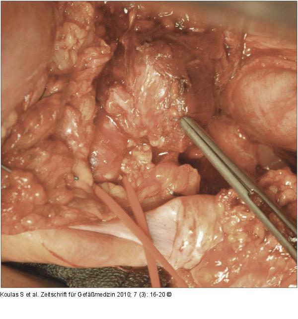 Aneurysma