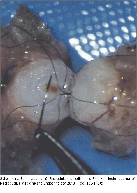 Vasovasostomie