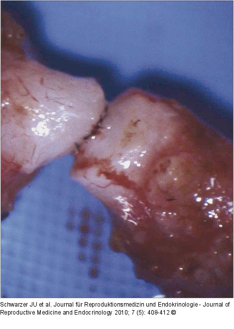 Vasovasostomie