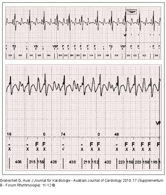 EKG