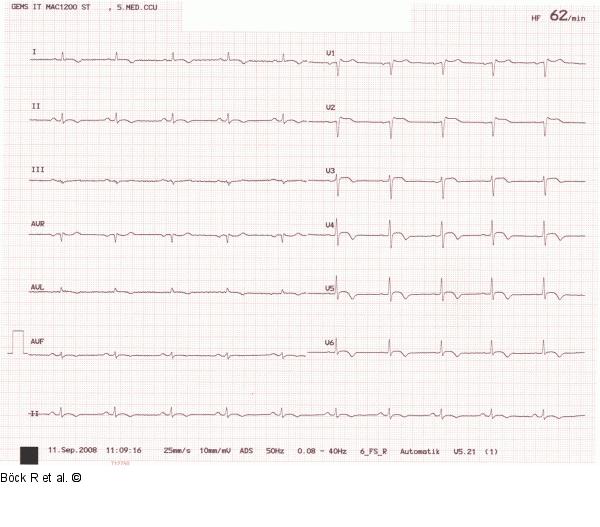EKG
