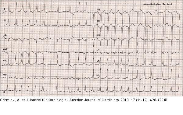 EKG