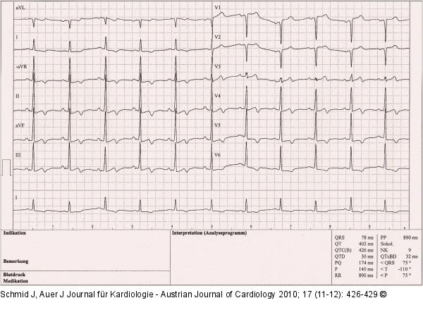 EKG