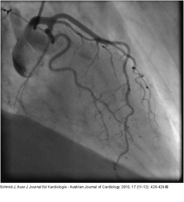 Koronararterie