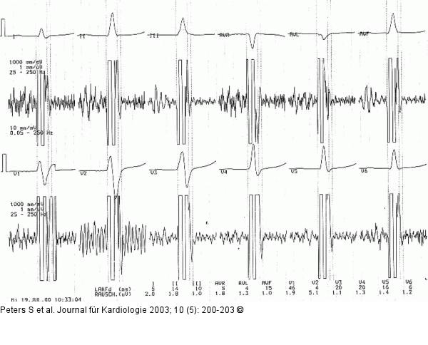 QRS-Komplex - Signalmittelung
