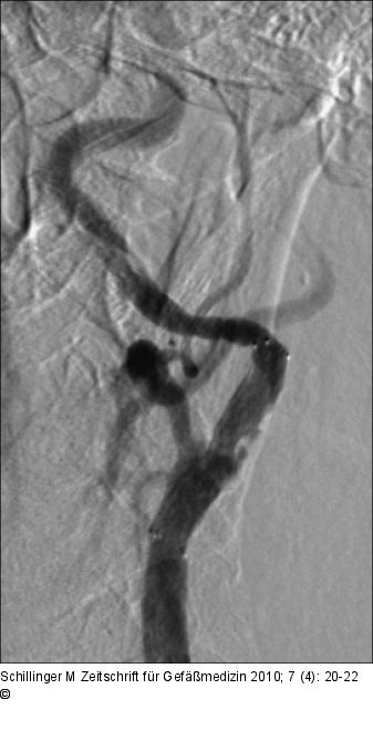 Angiographie - Stentimplantation