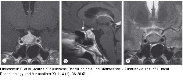 Lymphozytre Adenohypophysitis