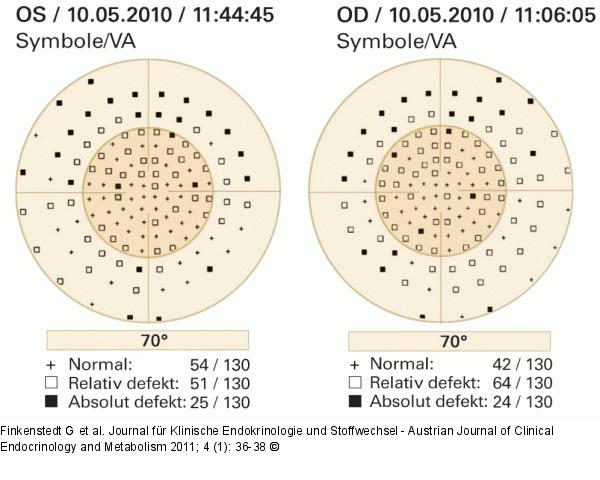 Lymphozytre Adenohypophysitis