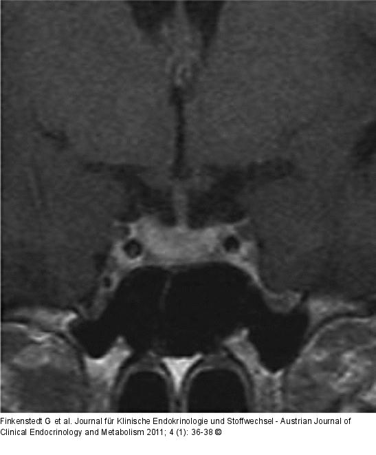 Lymphozytre Adenohypophysitis