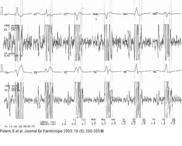 QRS-Komplex - Signalmittelung