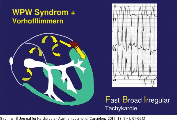 WPW-Syndrom