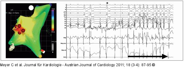 Katheterablation