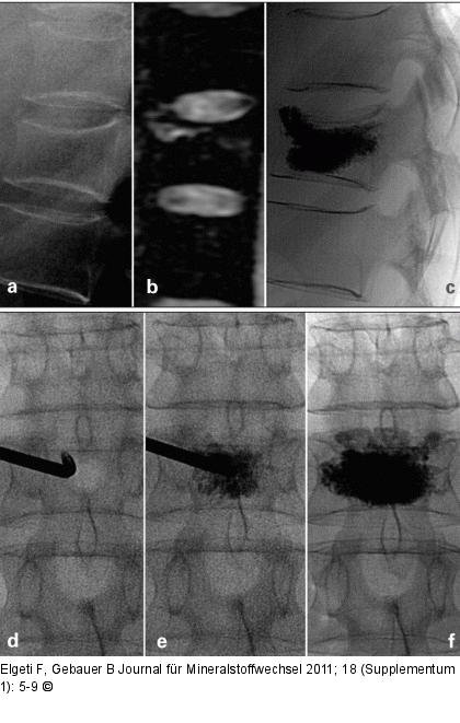 Vertebral body compression fracture