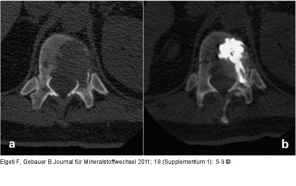 Neoplastic osteolysis