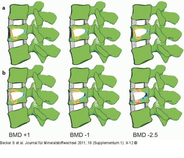 Bone densities