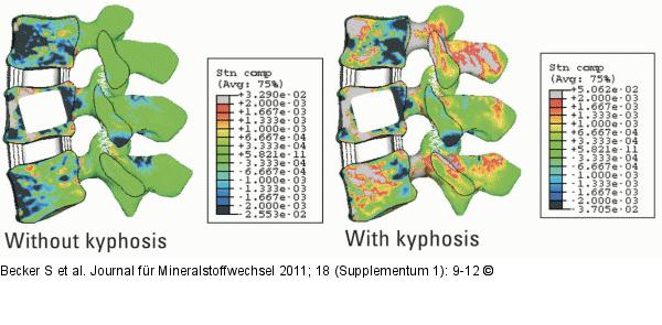 Kyphosis