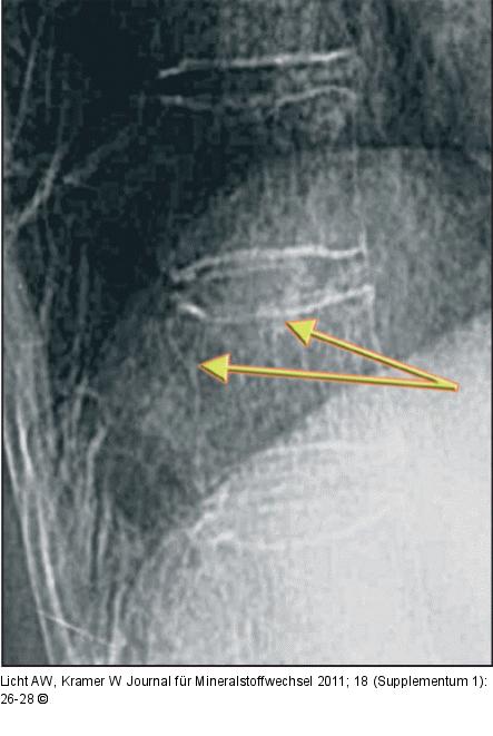 Thoracic vertebra