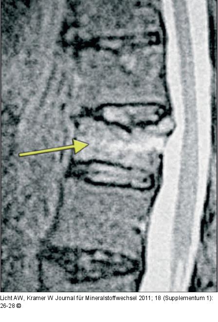 Thoracic vertebra