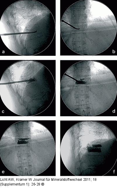 Course of surgery