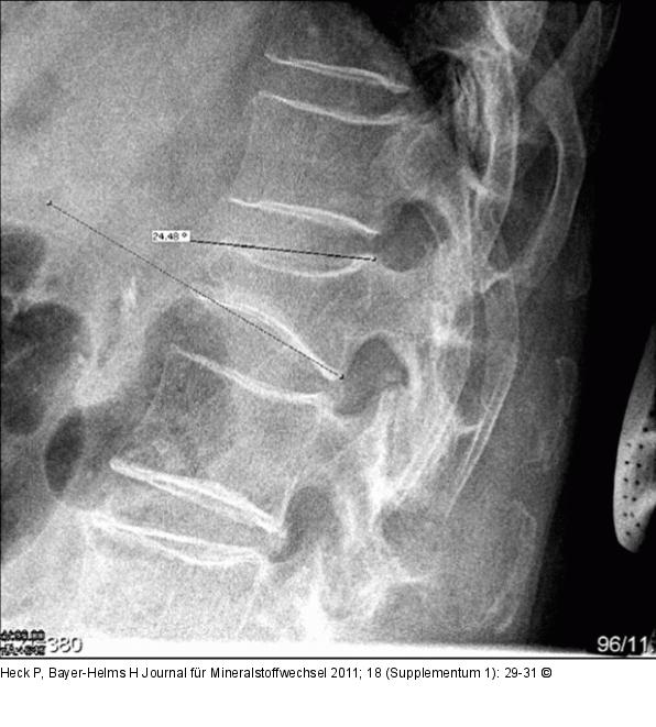 Lumbar vertebra