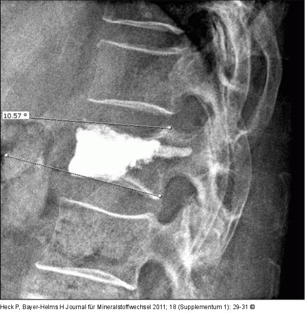 Lumbar vertebra