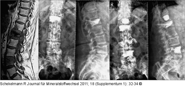 MRI STIR