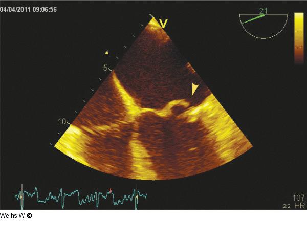 Transsophageales Echo