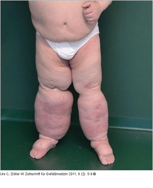 Chronisches Beinlymphdem