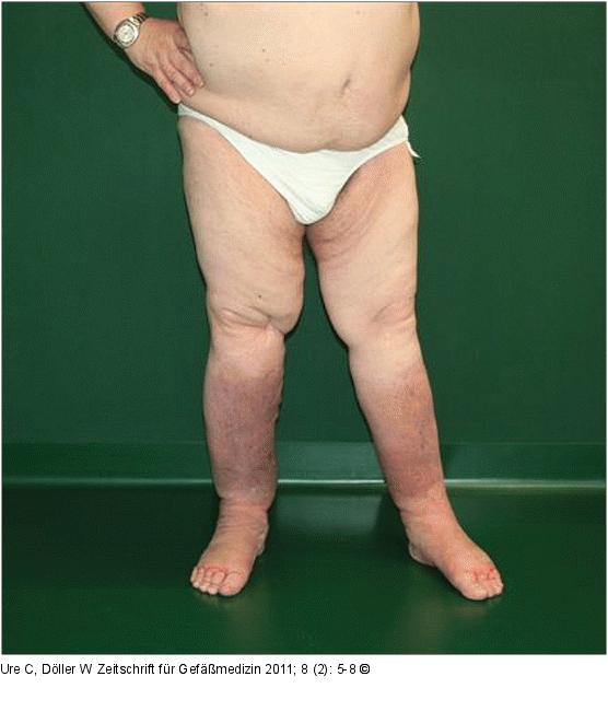 Chronisches Beinlymphdem nach 3 Wochen