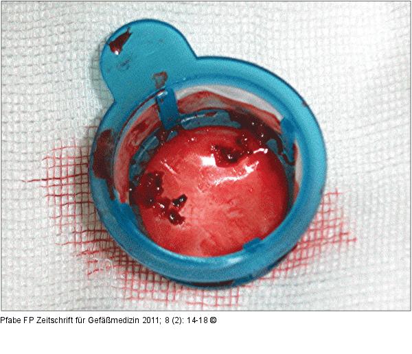 aspiriertes Thrombusmaterial