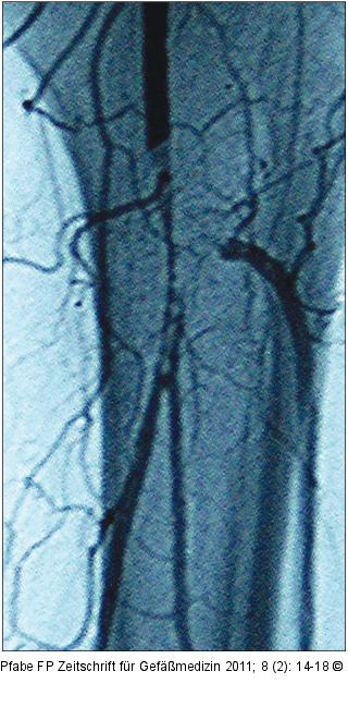 Thrombusaspirationsembolektomie