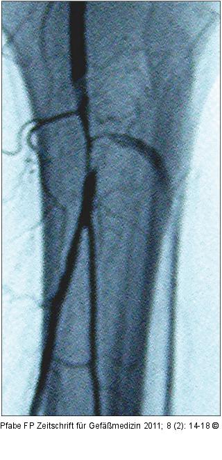 Thrombusaspirationsembolektomie