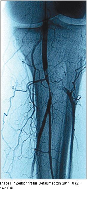 Thrombusverschleppung