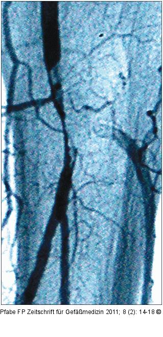 Thrombusverschleppung
