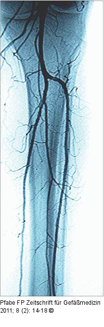 Angiographisches Ergebnis
