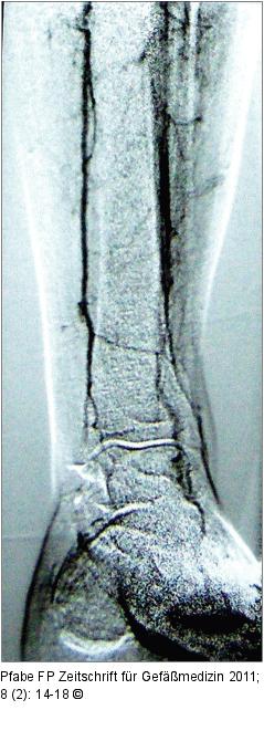 Angiographisches Ergebnis