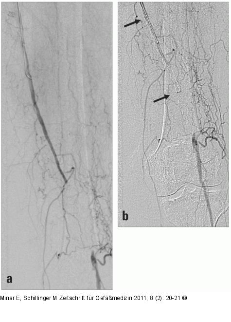 Verschluss der distalen Arterie femoralis superficia'is