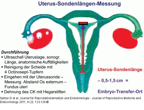 Uterus-Sondenlngen-Messung