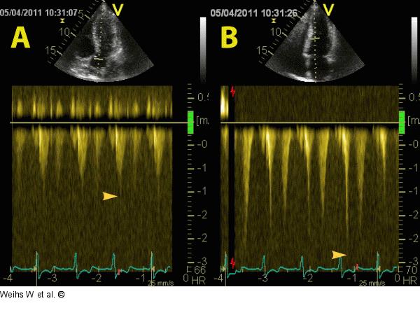 cw-Doppler im LVOT